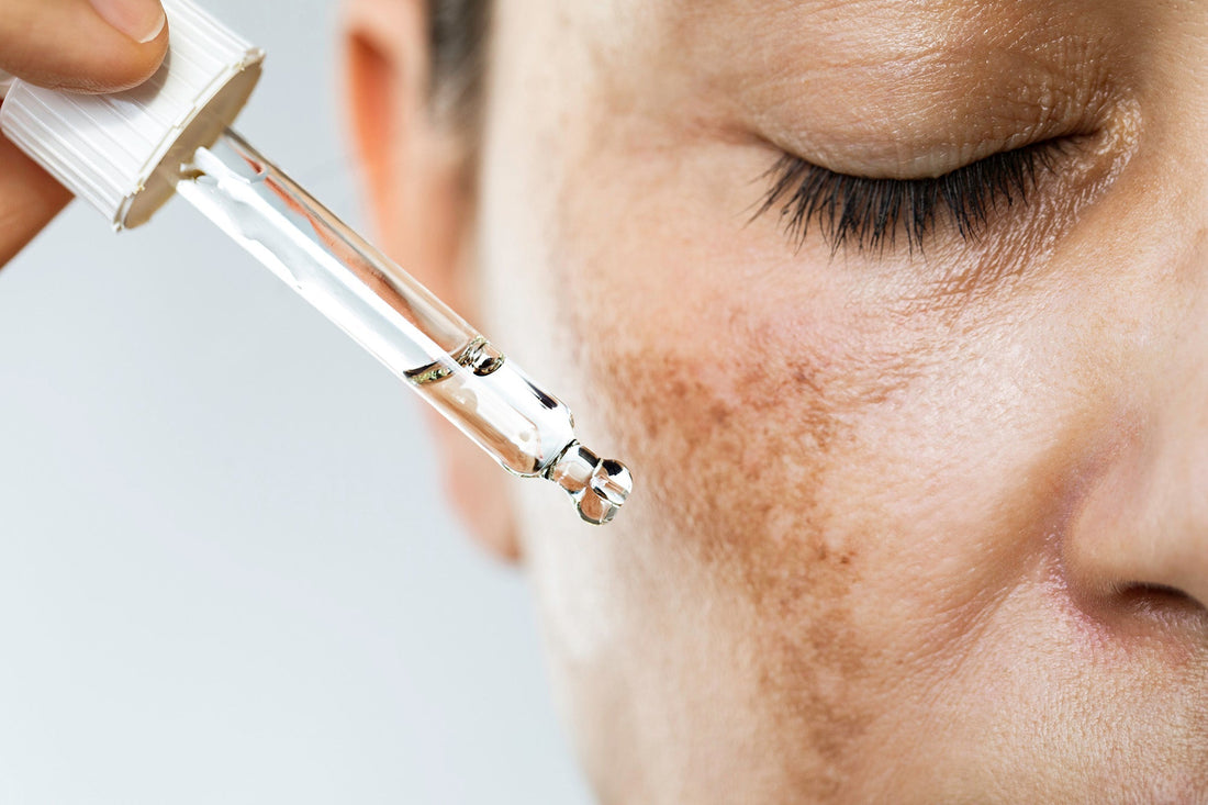 Post-Inflammatory Hyperpigmentation: Triggers and Treatment