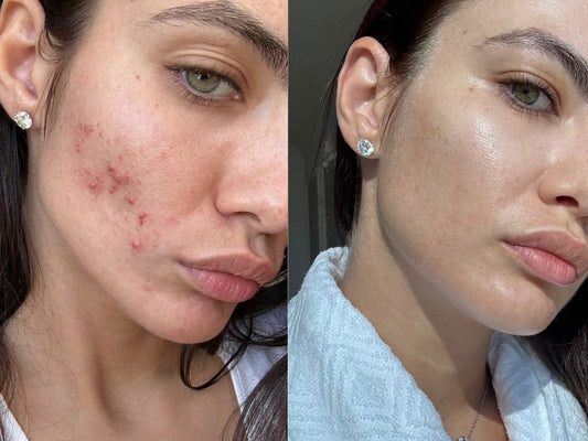 Serum for Redness: What Finally Calmed My Reactive Skin