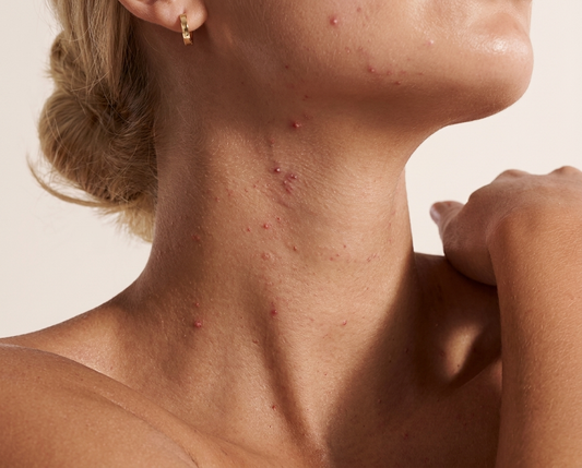 Neck Acne: Causes, Hormonal Triggers & Treatment