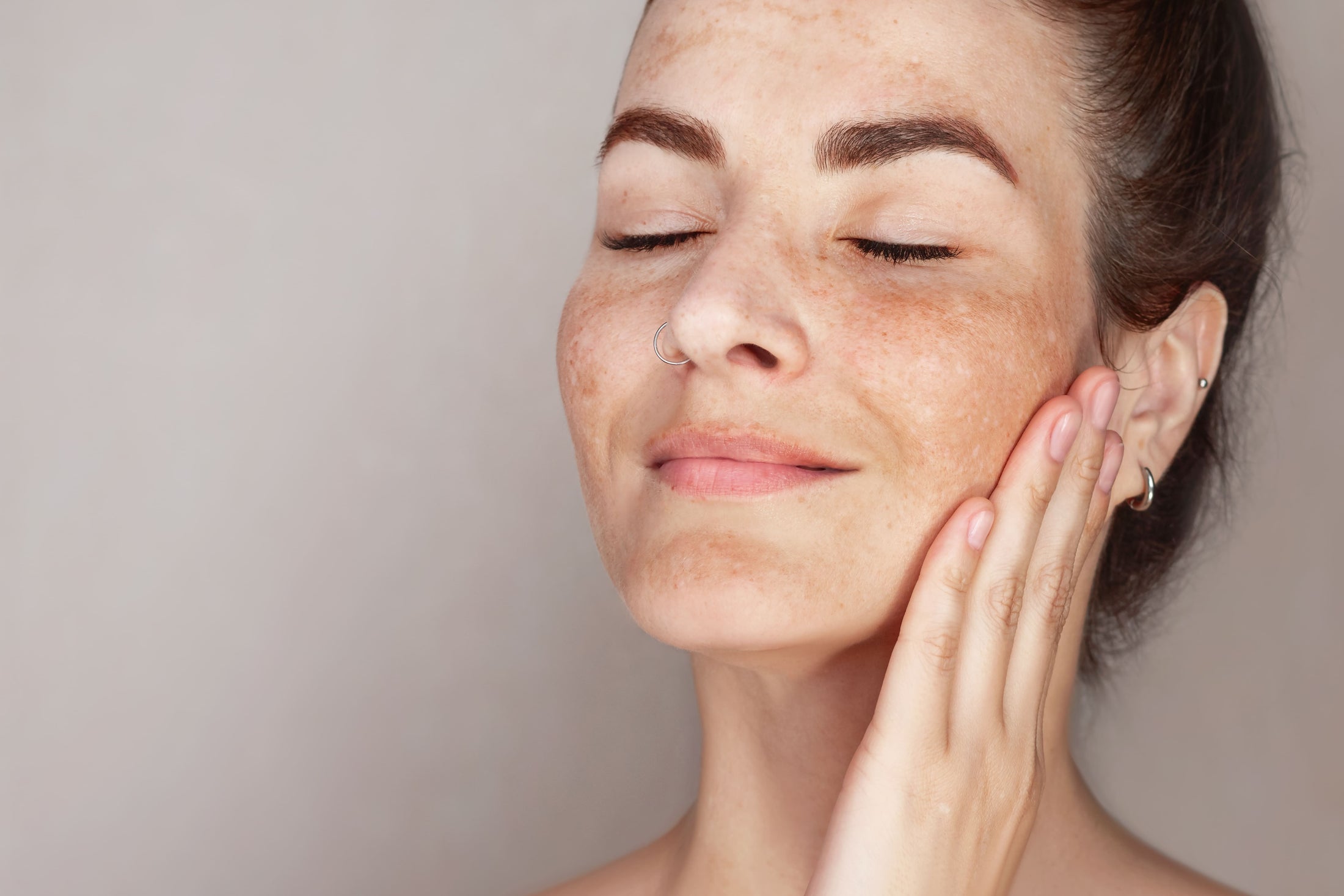 Melasma vs Hyperpigmentation: Key Differences & Treatment – OffWeGlow Store