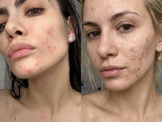 Red Marks vs Dark Marks After Acne: How to Tell Them Apart