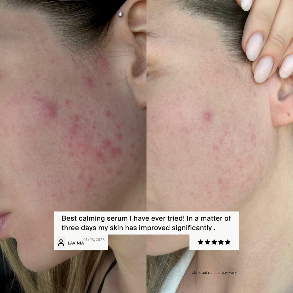 Before-and-after view of acne-prone skin showing reduced redness and blemishes after using Off We Glow Rush Hour Serum