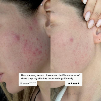 Before-and-after view of acne-prone skin showing reduced redness and blemishes after using Off We Glow Rush Hour Serum
